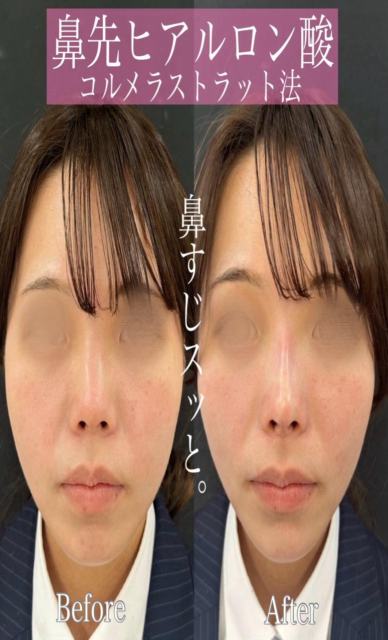 鼻ヒアルロン酸注入の症例写真