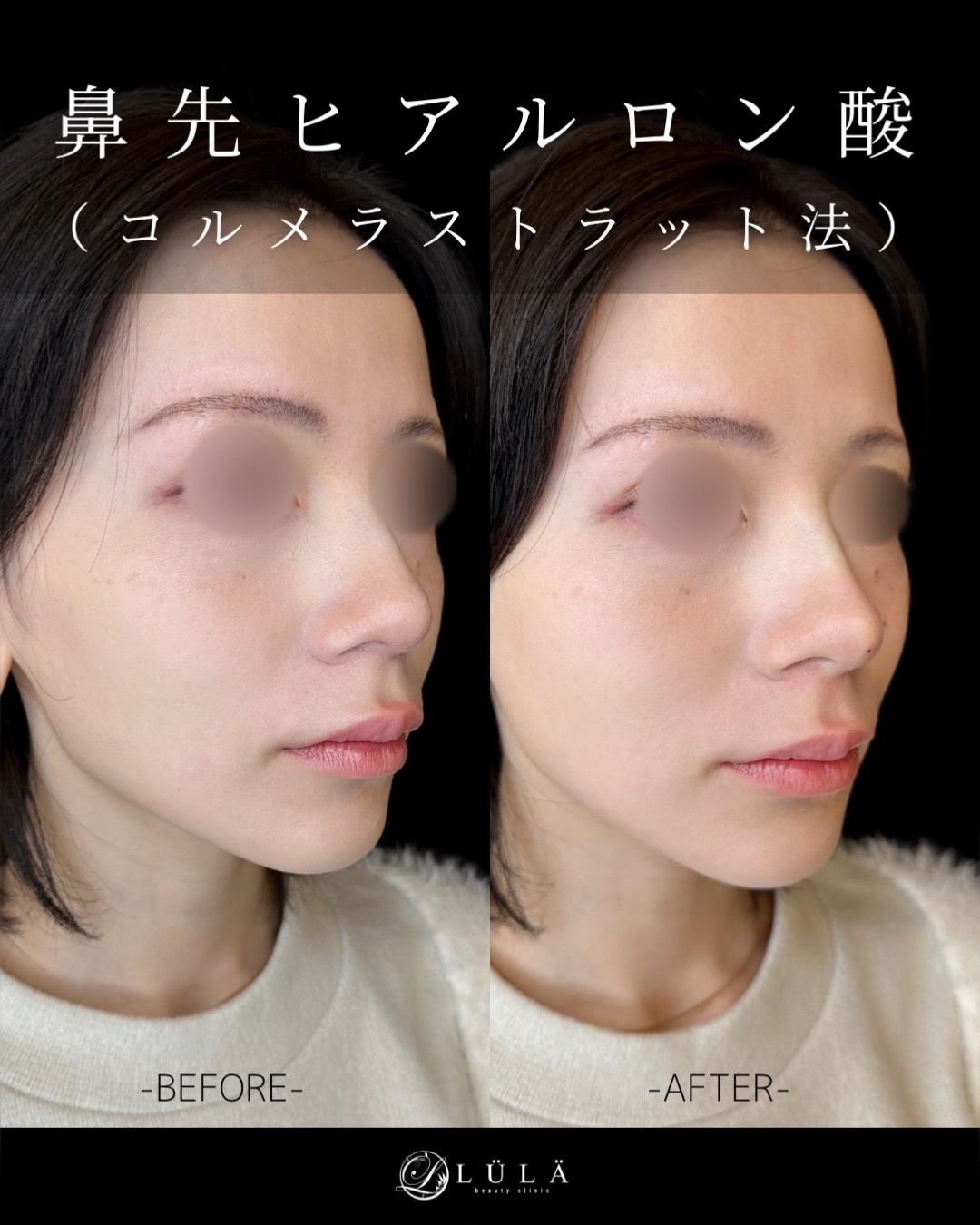 鼻ヒアルロン酸注入の症例写真