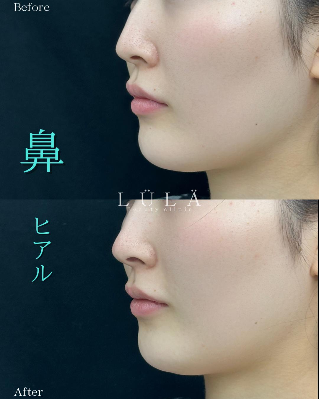 鼻ヒアルロン酸注入の症例写真