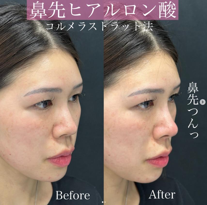 鼻ヒアルロン酸注入の症例写真
