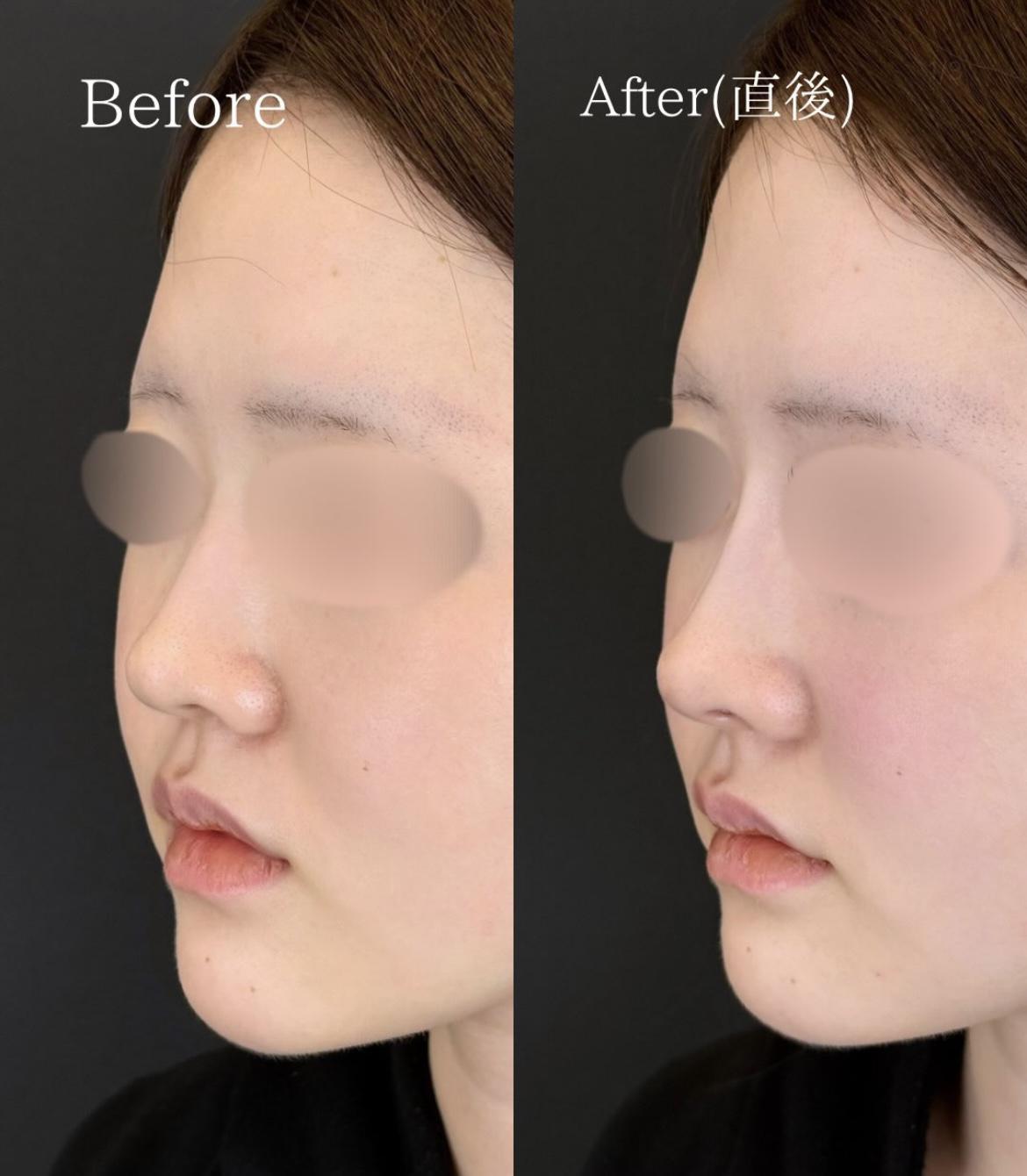 鼻ヒアルロン酸注入の症例写真