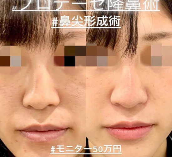 プロテーゼ隆鼻術の症例写真