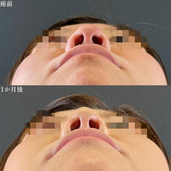 鼻尖形成術