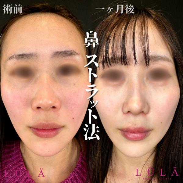 鼻尖形成術