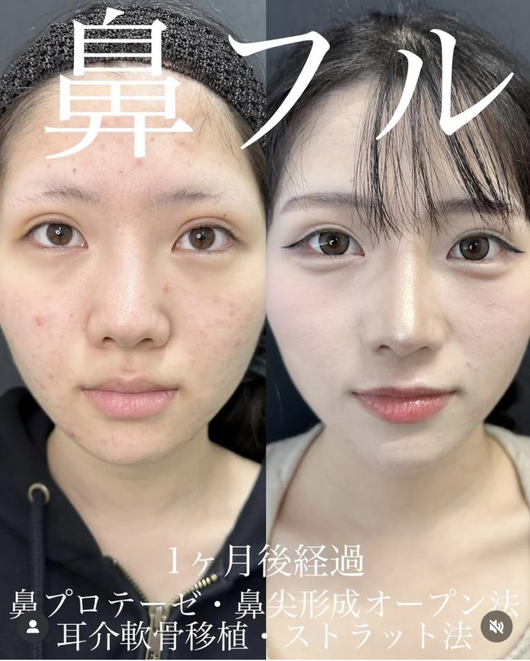鼻尖形成術