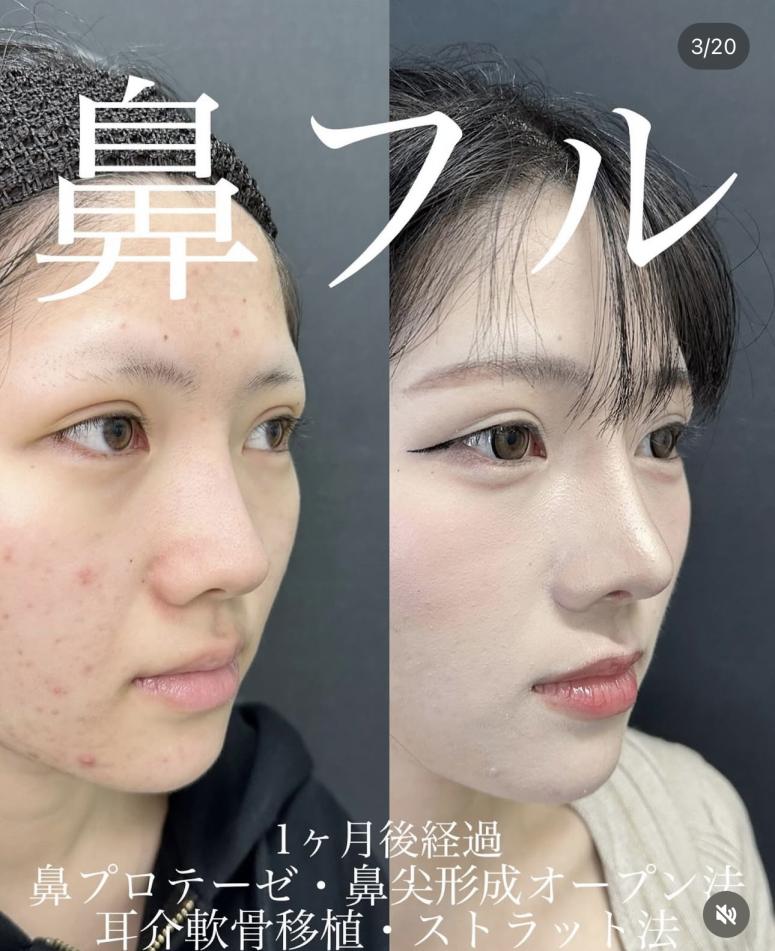 鼻尖形成術