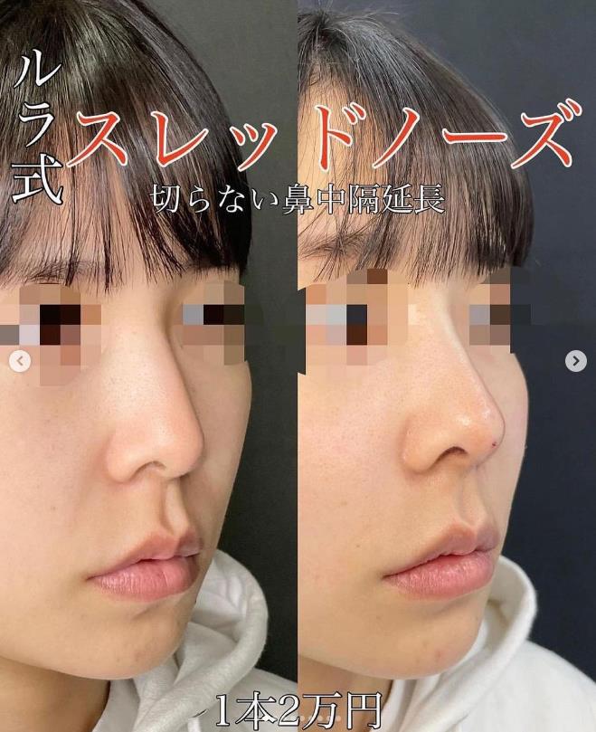 ルラ式スレッドノーズの症例写真