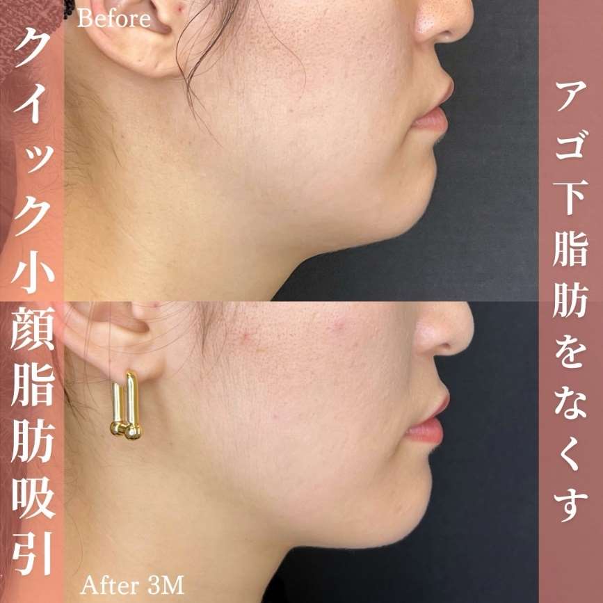 ルラ式クイック小顔脂肪吸引