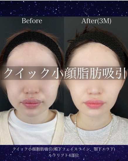 ルラ式クイック小顔脂肪吸引
