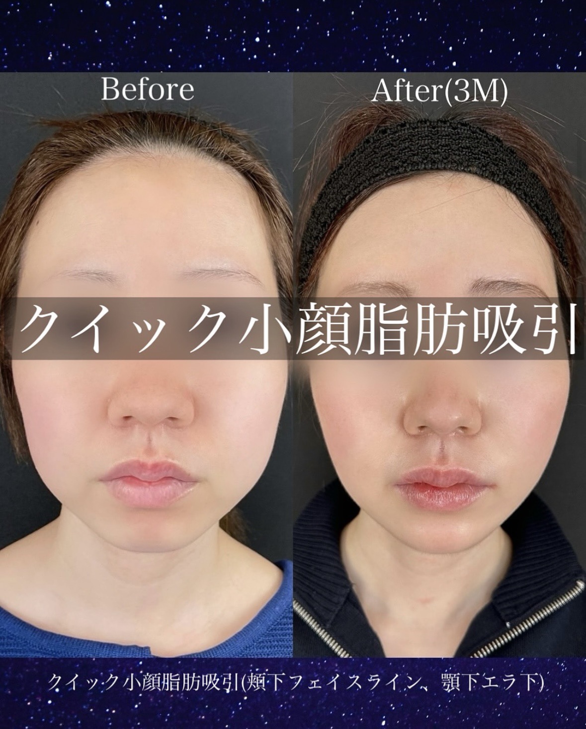ルラ式クイック小顔脂肪吸引