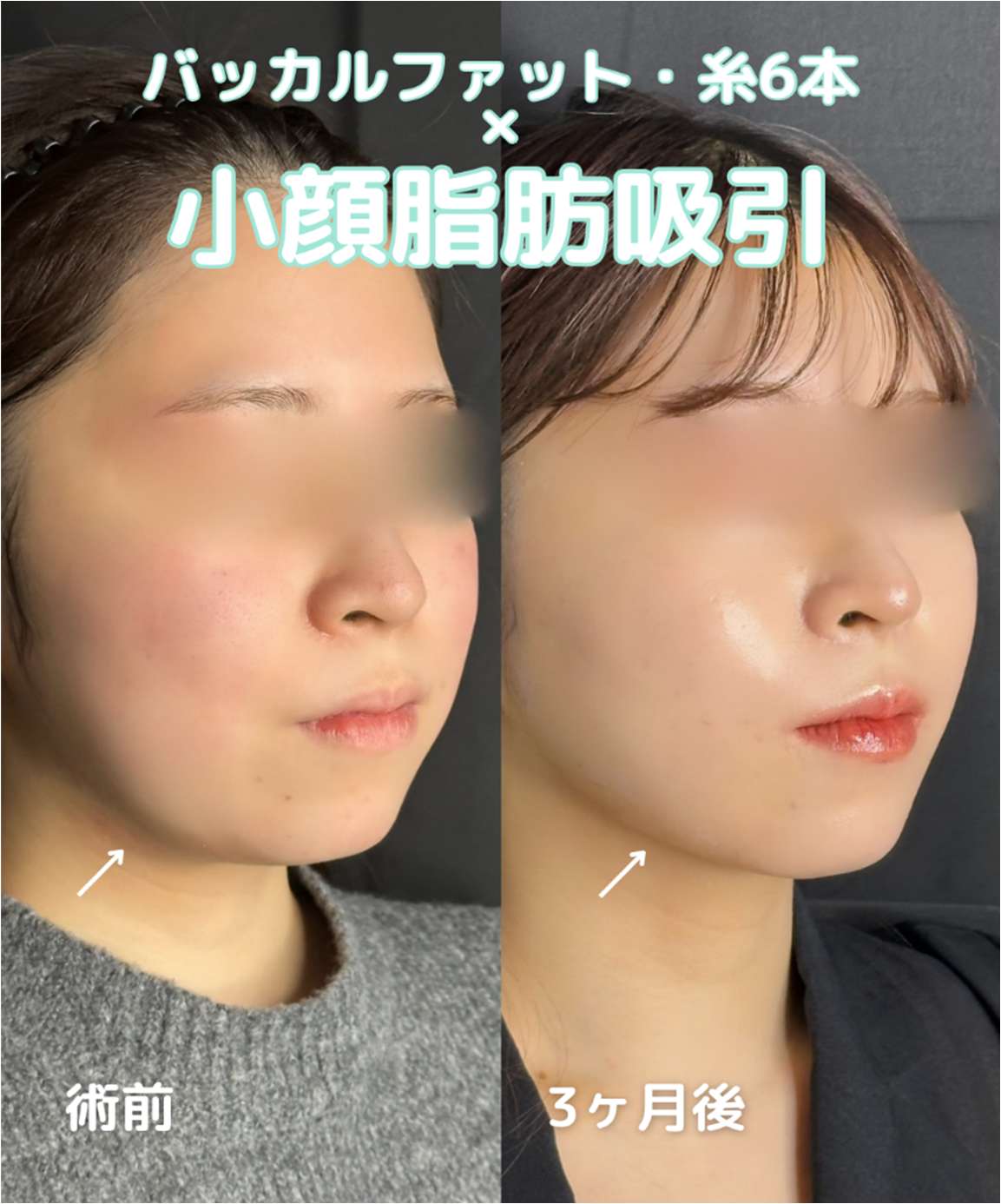 ルラ式クイック小顔脂肪吸引