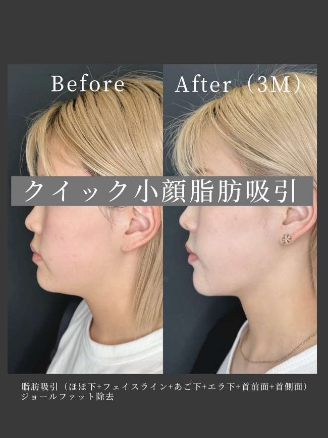 ルラ式クイック小顔脂肪吸引