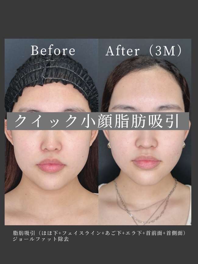 ルラ式クイック小顔脂肪吸引