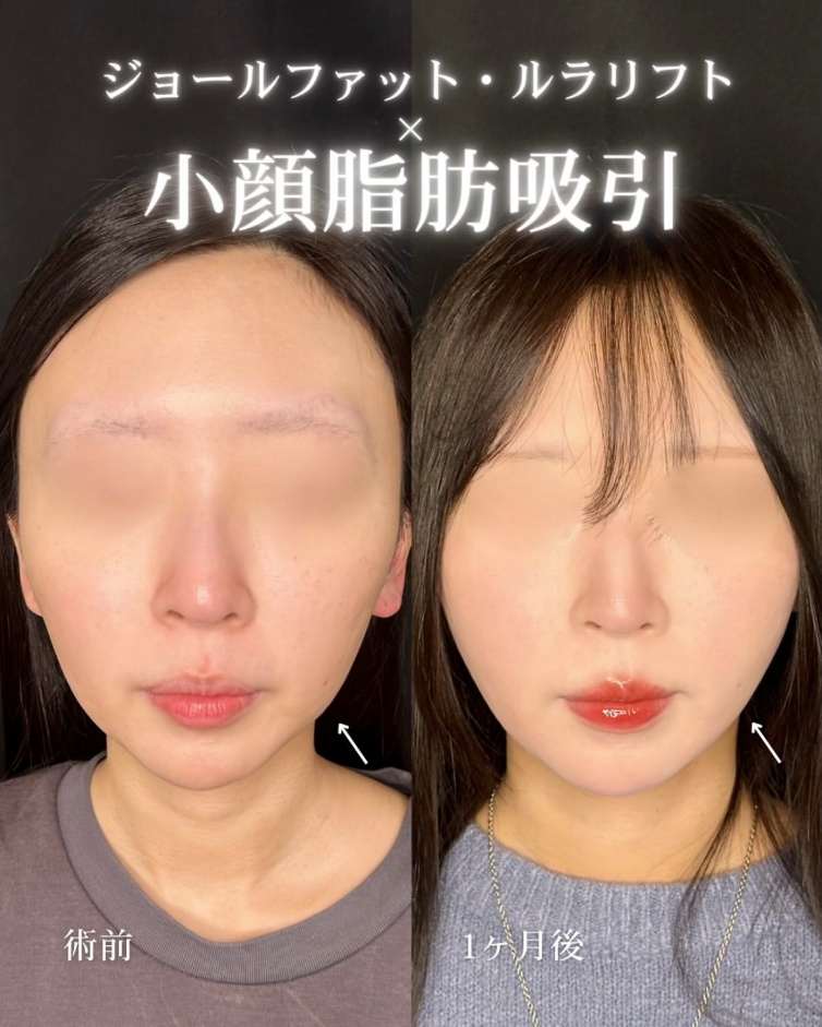 ルラ式クイック小顔脂肪吸引