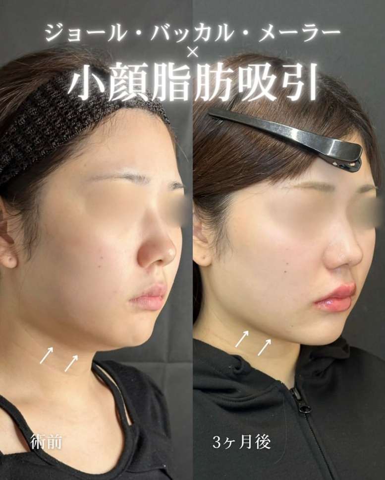 ルラ式クイック小顔脂肪吸引