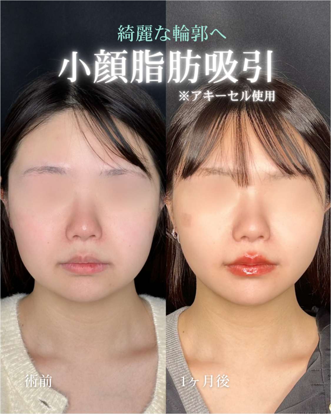 ルラ式クイック小顔脂肪吸引