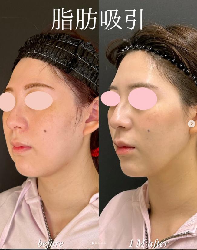 ルラ式クイック小顔脂肪吸引