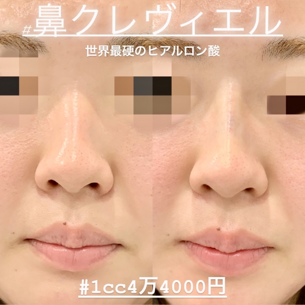 クレヴィエルの7つの特徴 注意点 世界最硬のヒアルロン酸 顔 コラム ルラ Lula 美容クリニック クレヴィエルの7つの特徴 注意点 世界最硬のヒアルロン酸 顔 コラム ルラ Lula 美容クリニック
