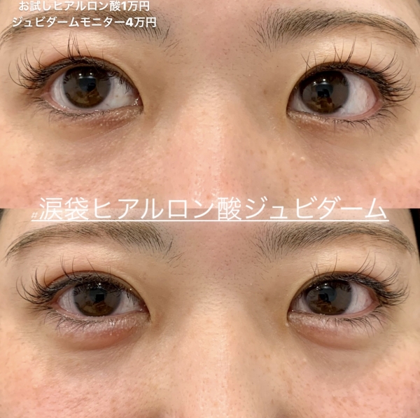 涙袋のヒアルロン酸注入の腫れ ダウンタイム 5つのメリット 顔 コラム ルラ Lula 美容クリニック 涙袋のヒアルロン酸注入の腫れ ダウンタイム 5つのメリット 顔 コラム ルラ Lula 美容クリニック