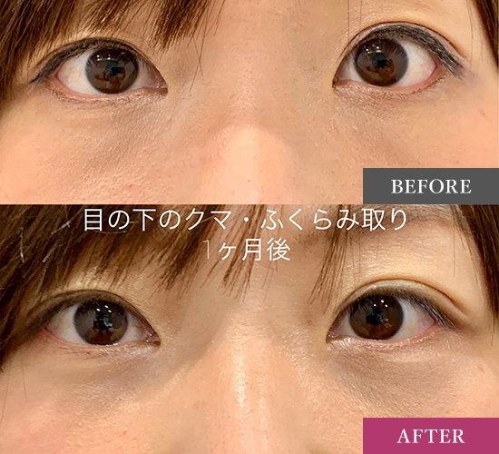 目の下のふくらみ取り（経結膜脱脂術）の症例写真
