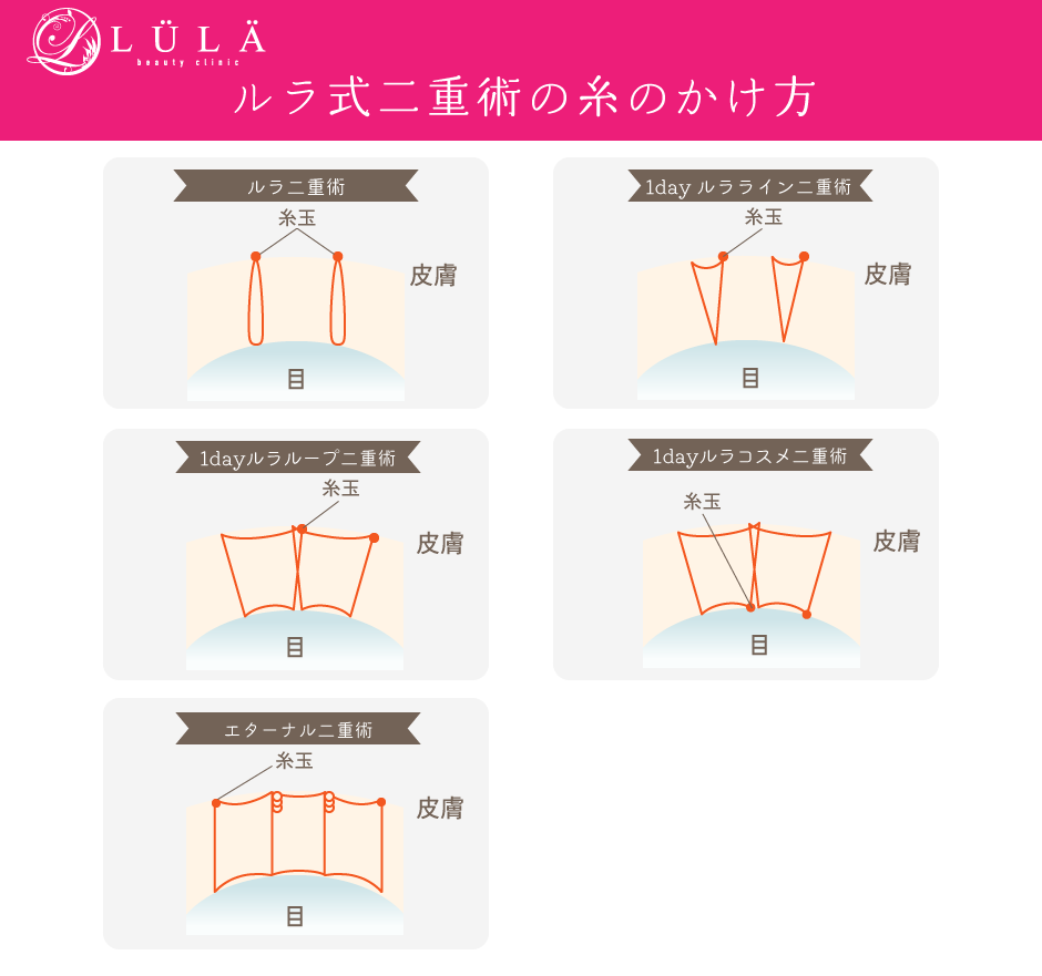 ルラ式二重術の糸かけ方