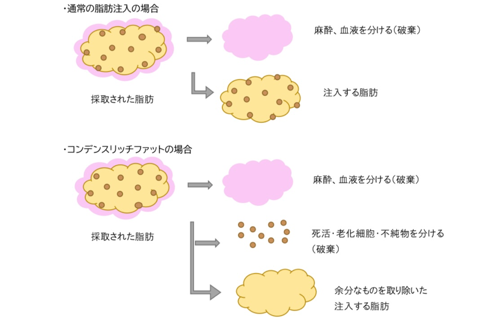 脂肪注入違い