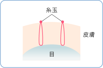 二重埋没法メニュー料金