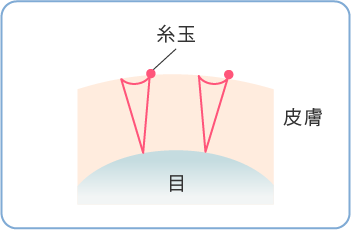 二重埋没法メニュー料金