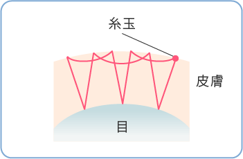 二重埋没法メニュー料金