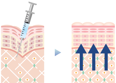スネコス注射の仕組み