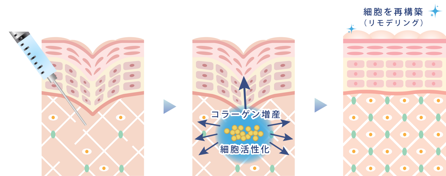 プロファイロの場合