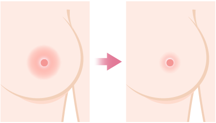 乳輪縮小イメージ画像