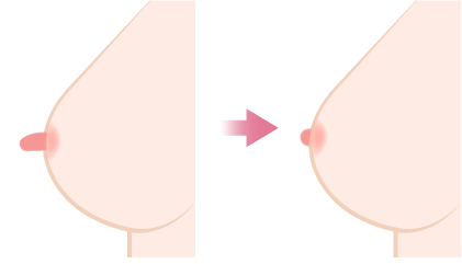 乳頭縮小イメージ画像
