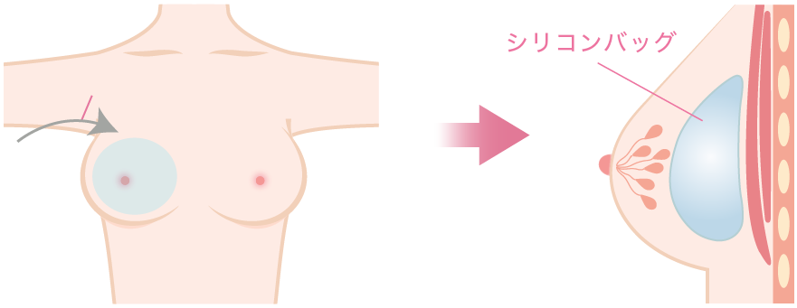 シリコンバッグ