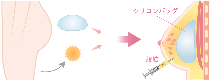 ハイブリッド豊胸