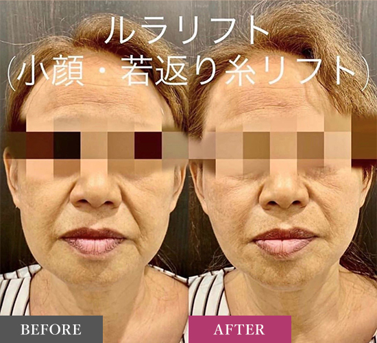 糸リフト（ルラリフト）の症例写真