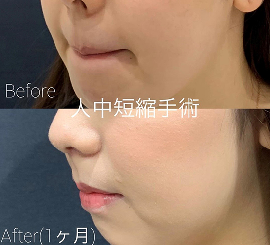 人中短縮手術(リフトアップ)の症例写真