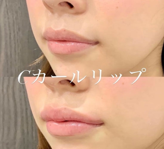 Cカールリップの症例写真