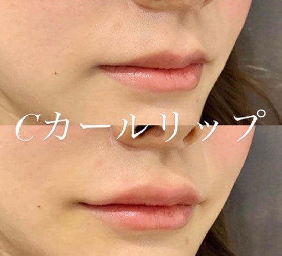 Cカールリップの症例写真