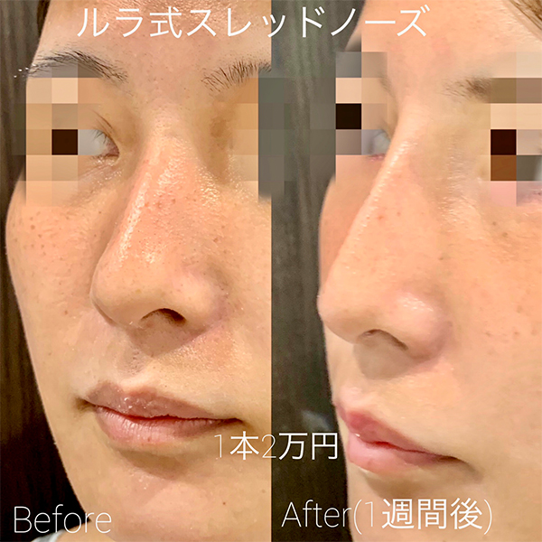 ルラ式スレッドノーズの症例写真