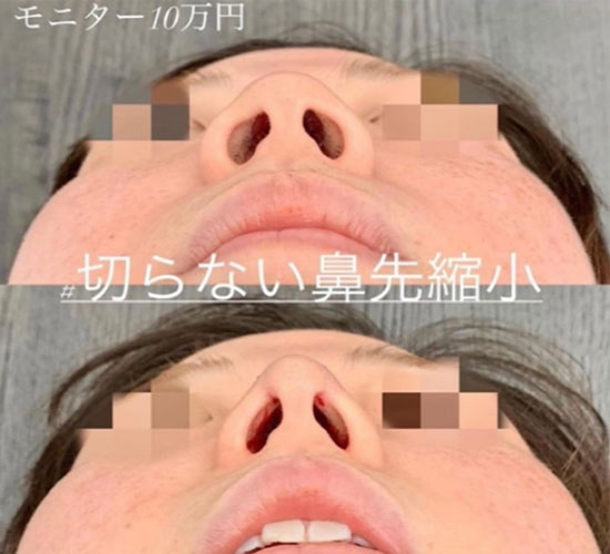 切らない鼻先縮小術の症例写真