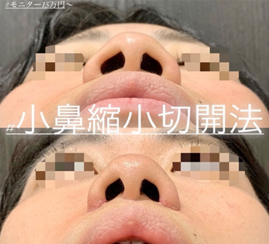 小鼻縮小切開の症例写真