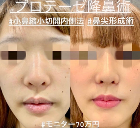 プロテーゼ隆鼻術の症例写真
