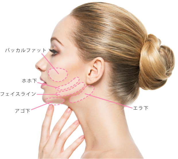 ルラ式クイック小顔脂肪吸引の適応箇所