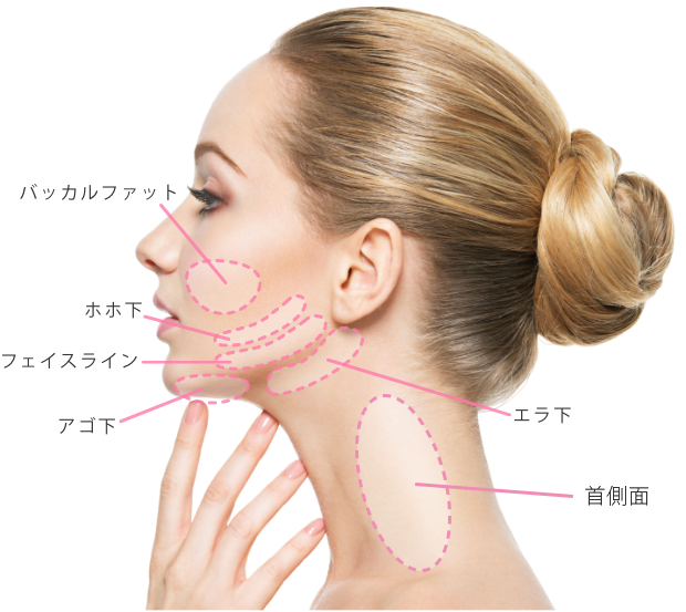 ルラ式クイック小顔脂肪吸引の適応箇所
