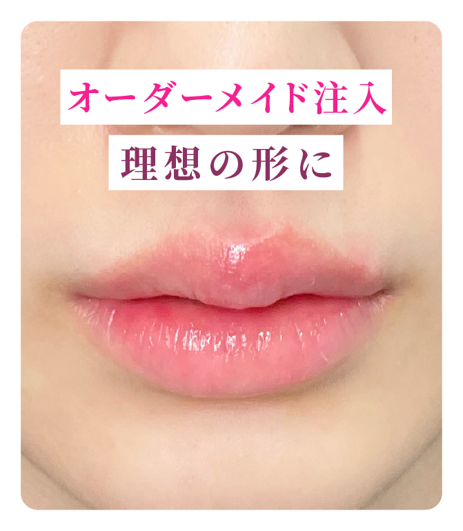 オーダーメイド注入 理想の形に