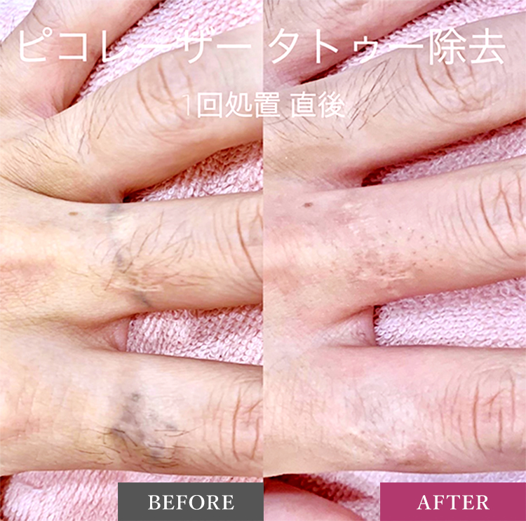 タトゥー除去の症例写真